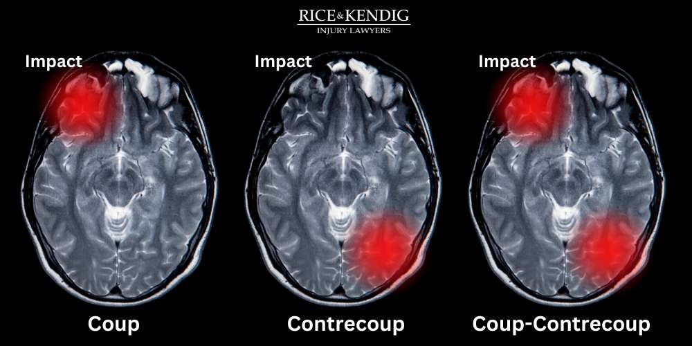 contrecoup brain injury